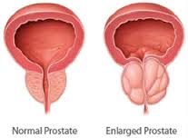 Prostate 101
